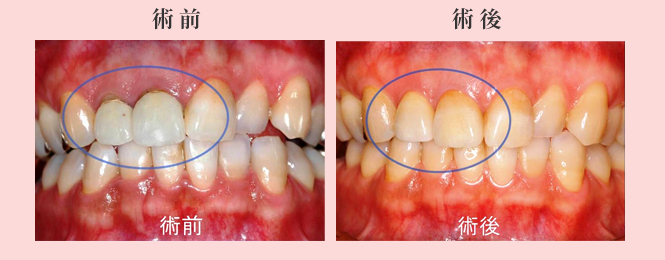 審美歯科の治療例