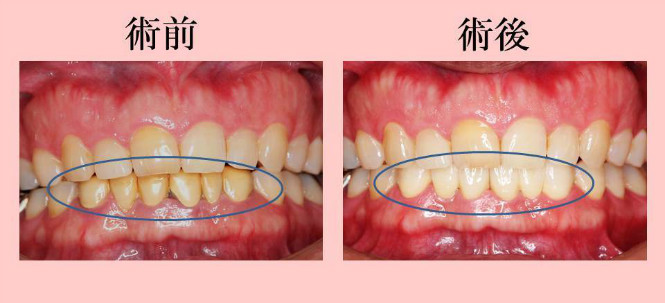 審美歯科の治療例