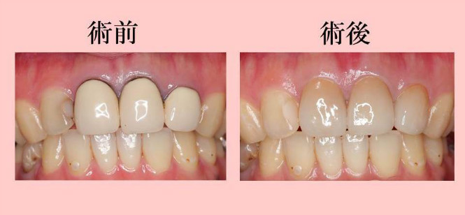 審美歯科の治療例